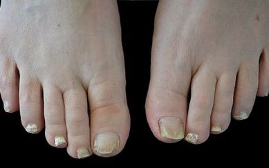 How to get rid of the mushroom on the fingers