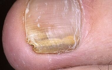 Mushroom manifestations on the thumb of the leg