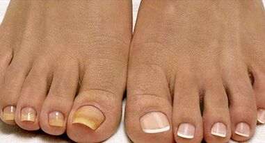 Mushrooms of the fleet mushroom treatment