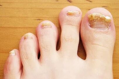 Nail fungus