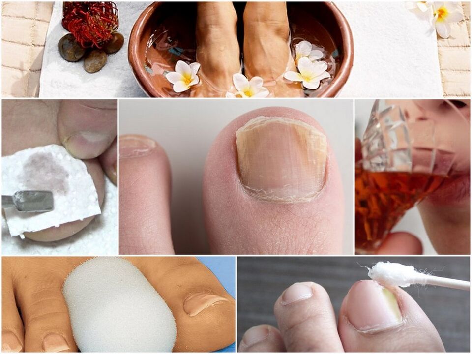 Treatment of nail mushrooms