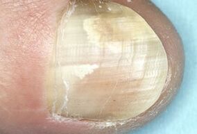 damage to the nail plate due to a fungal infection