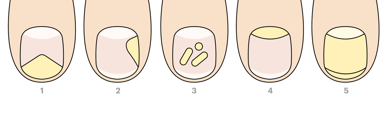 types of toenail fungi