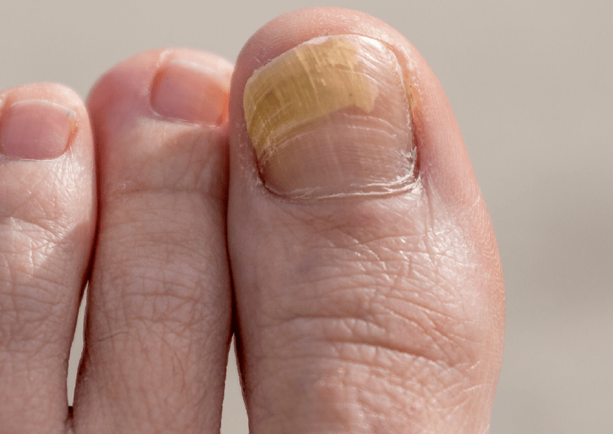 fungus on the big toe nail