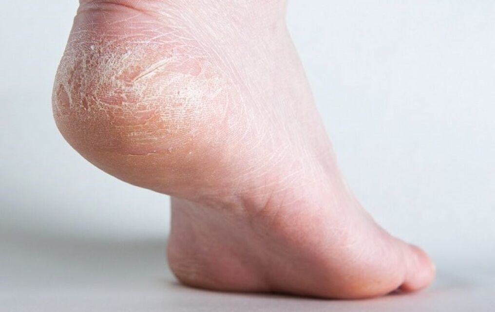 fungus on the skin of the feet